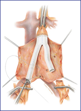 Aorta - Abbildung 1