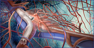 Aorta - Abbildung 2