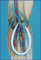 Dialyseshunts